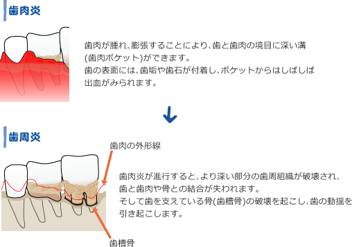 歯周病